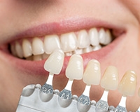 Veneers Image